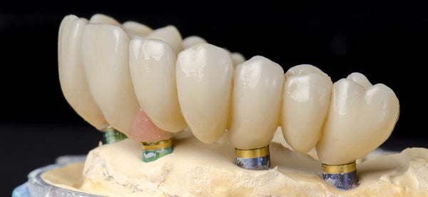 Dantų implantacija ir su ja susijusios paslaugos